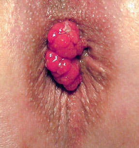 prolapsed-internal-hemorrhoids